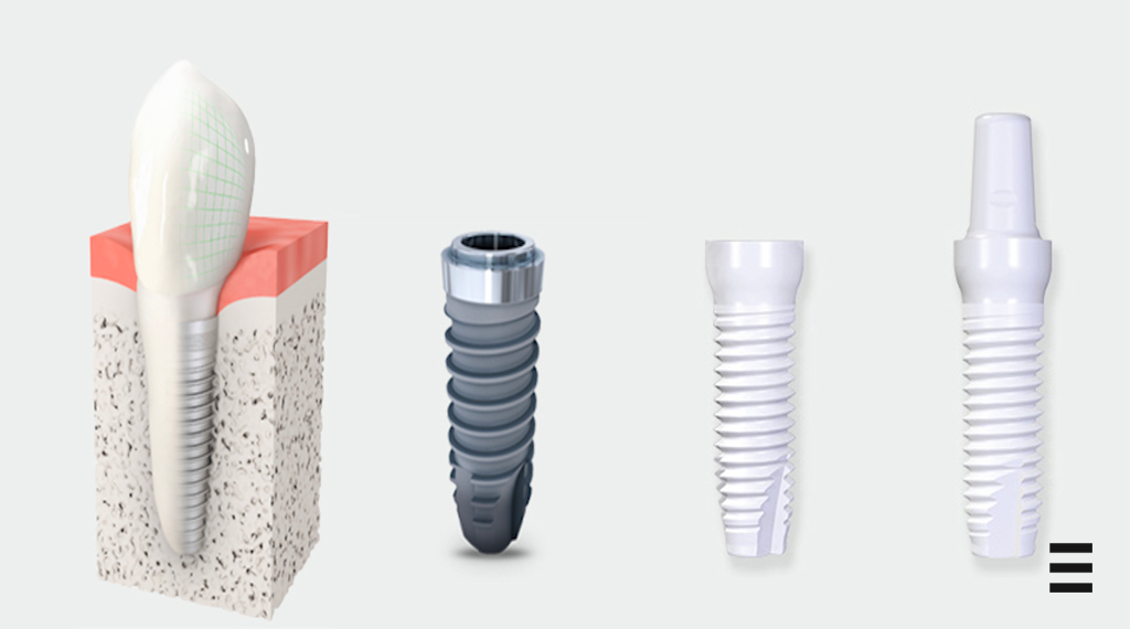 L'implant zircone